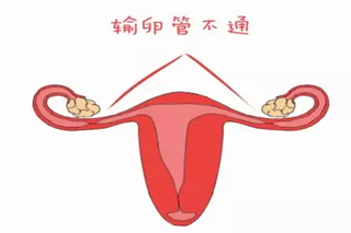 输卵管疾病是如何影响女性怀孕的？