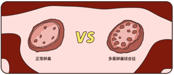 多囊卵巢综合征患者，为什么一定要早睡？